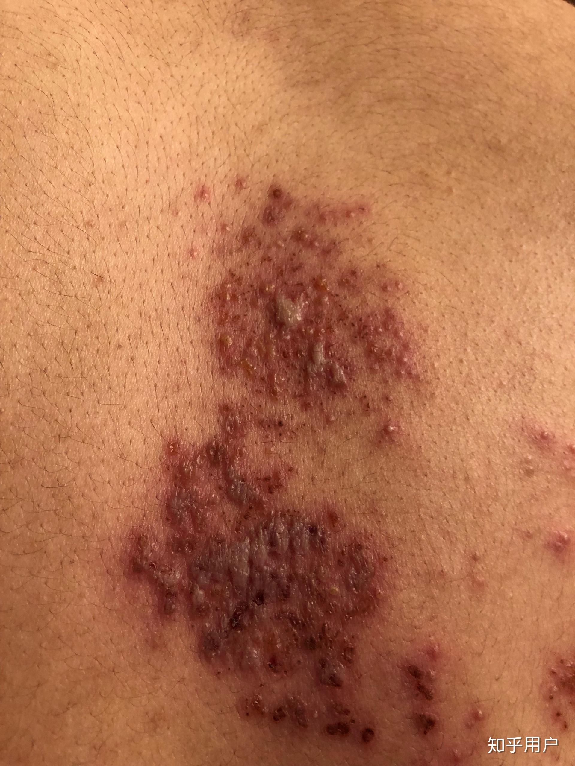 什么是神经性带状疱疹有办法医治吗