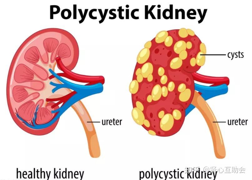 带您了解遗传性肾病多囊肾