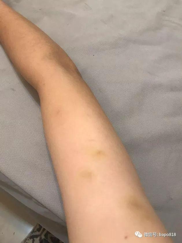 验伤单和照片显示女受害者下体有多处撕裂伤以及肢体淤青.