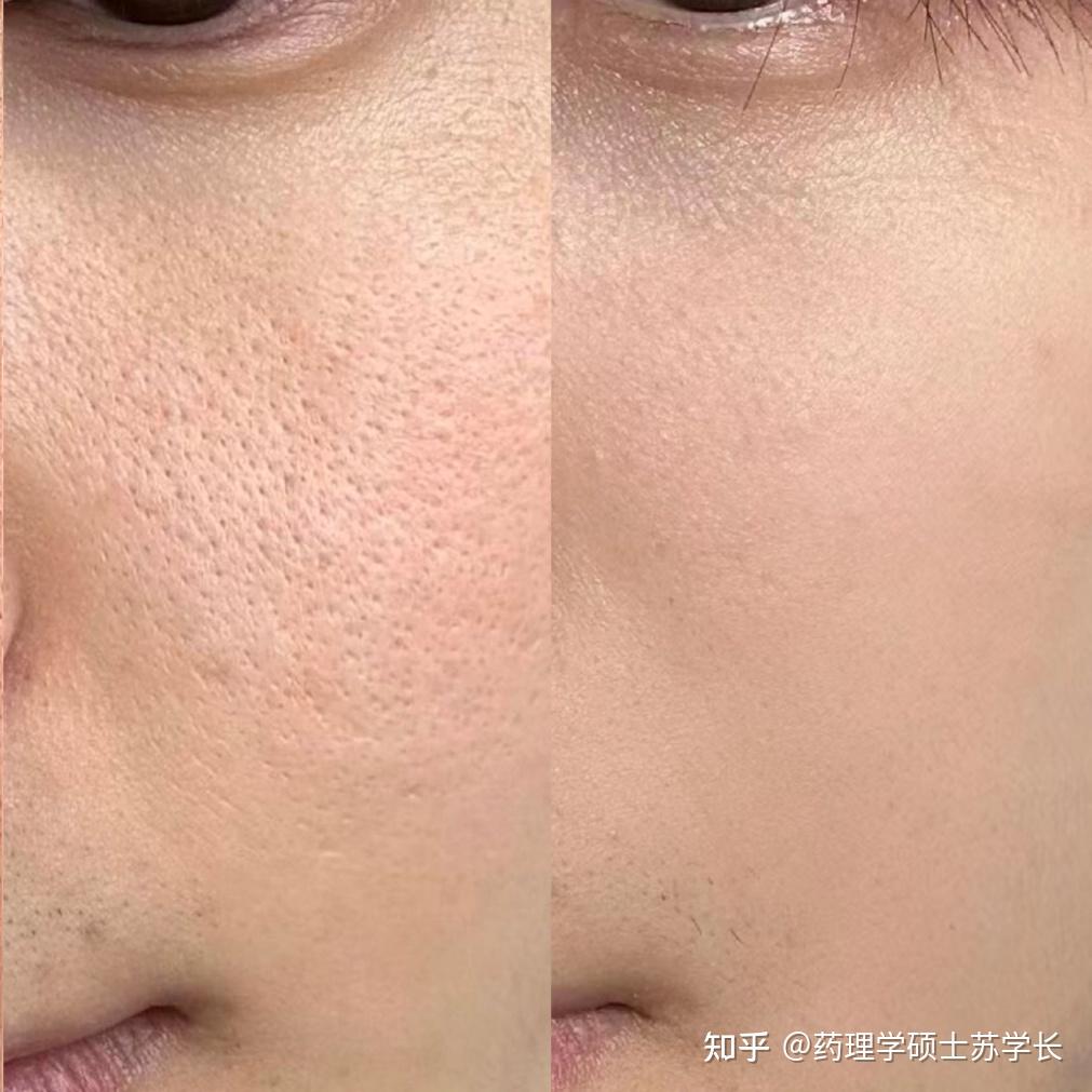 男生脸上毛孔密密麻麻粗大得像蜂窝、还总是出油脏兮兮的,到底应该怎么办?医学生教你4步摆脱粗大毛孔,男生一个月收缩毛孔方法大公开! - 知乎