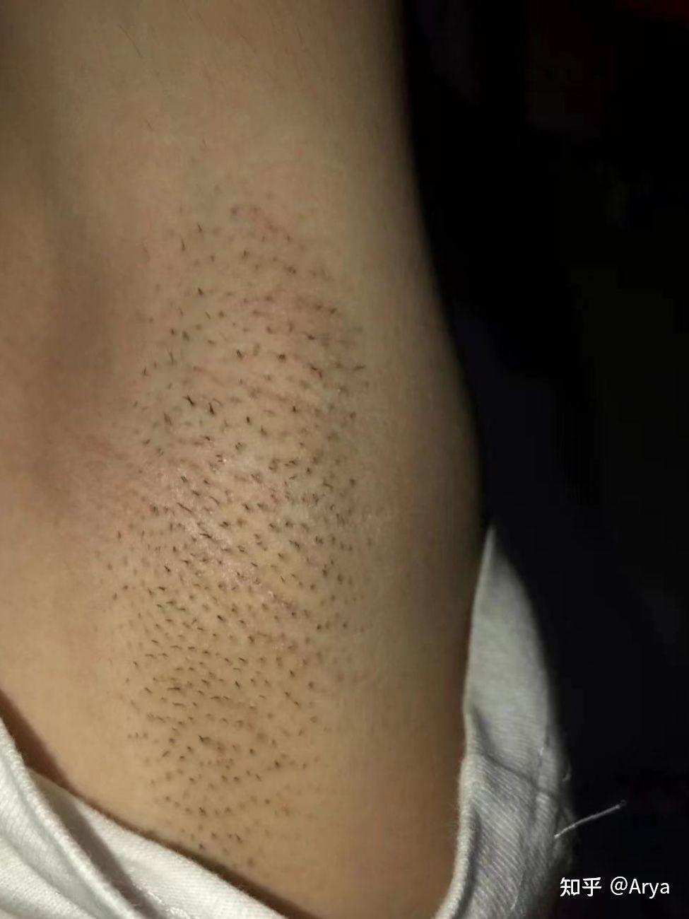 脱毛会更多更粗?永久脱毛可以实现?你关心的毛毛问题都在这里!