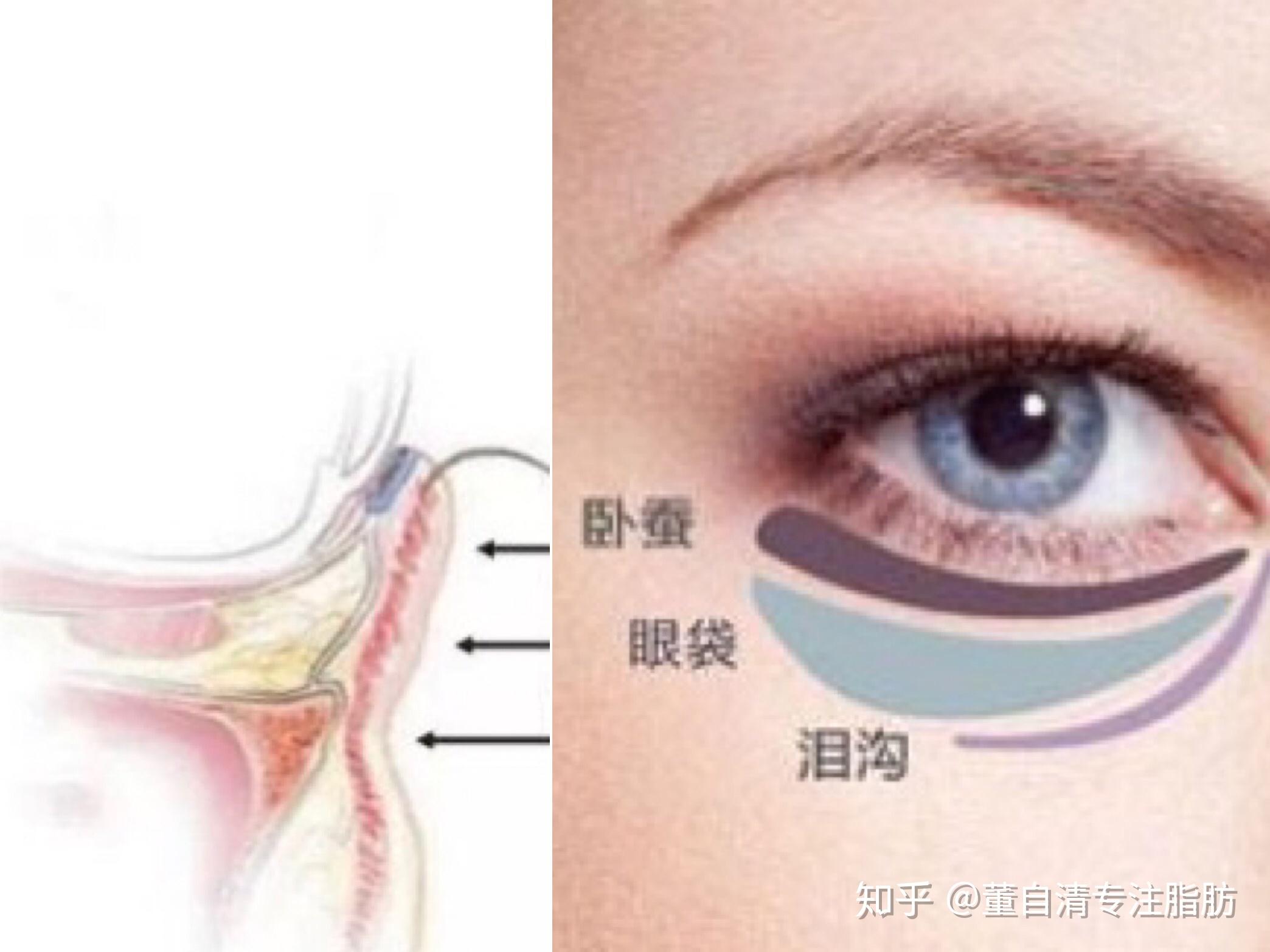 祛除眼袋内切好还是外切好