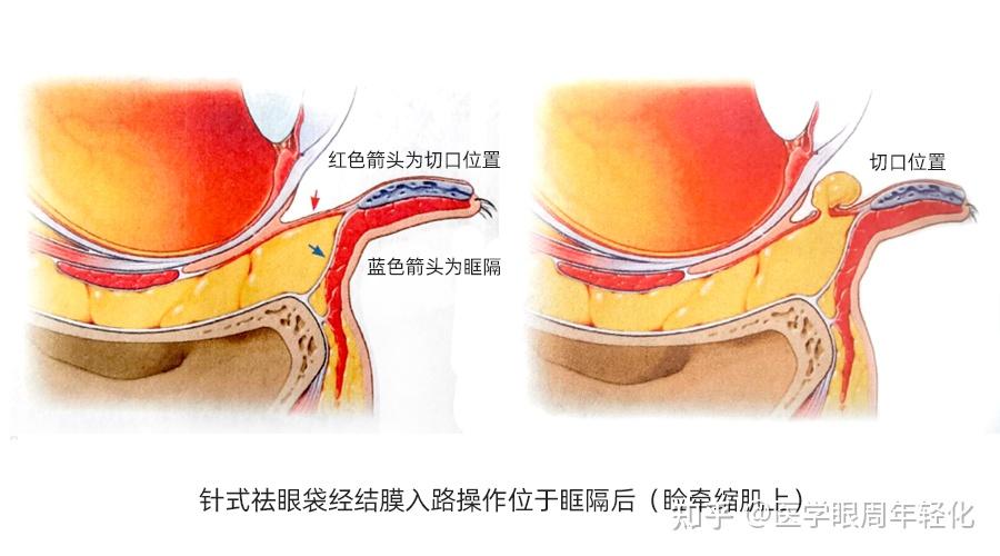 外眦解剖图图片