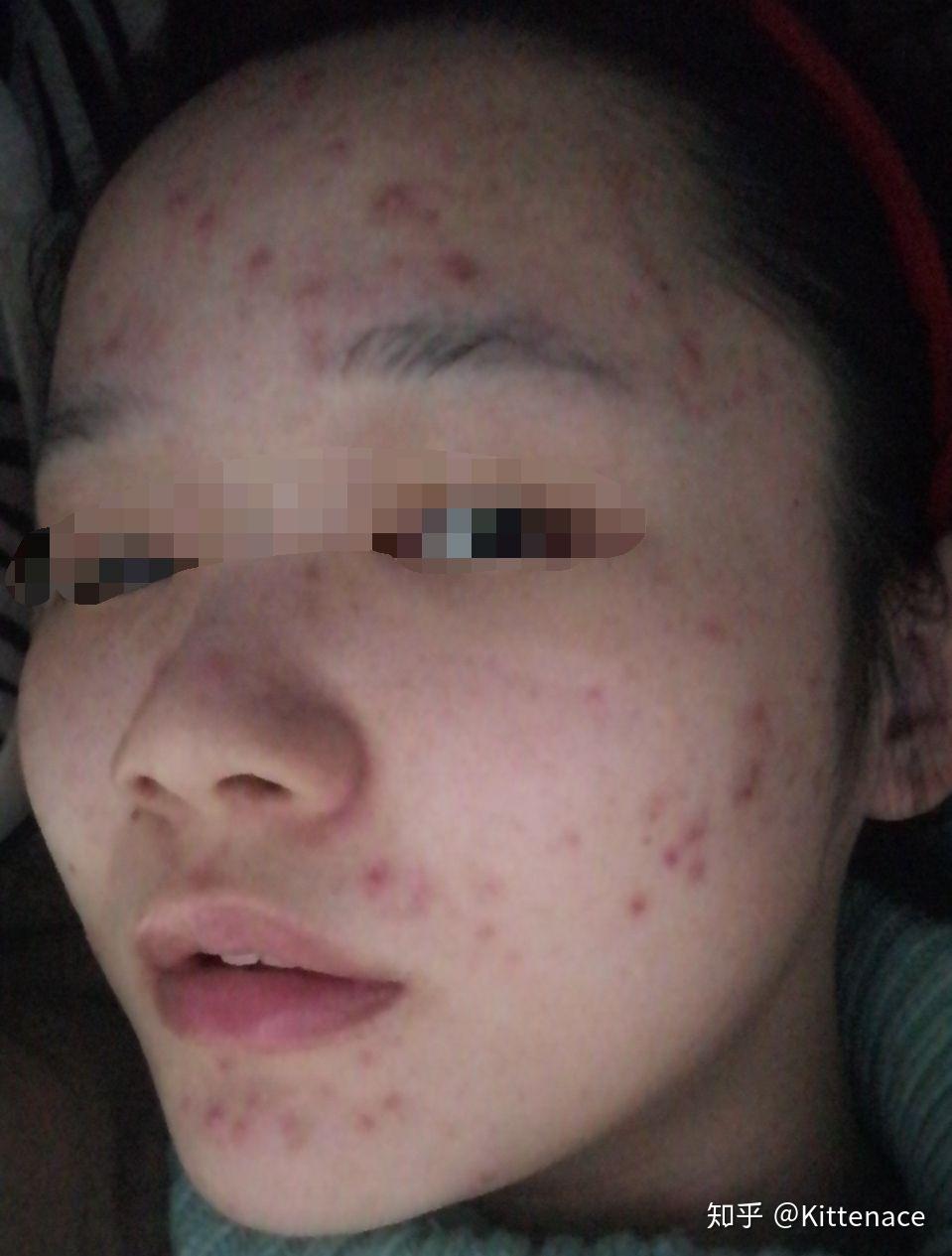 莫名奇妙的长痘烂脸日记