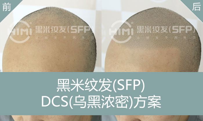 纹发后还看得出秃头吗？揭秘纹发效果与持久性！ - 知乎