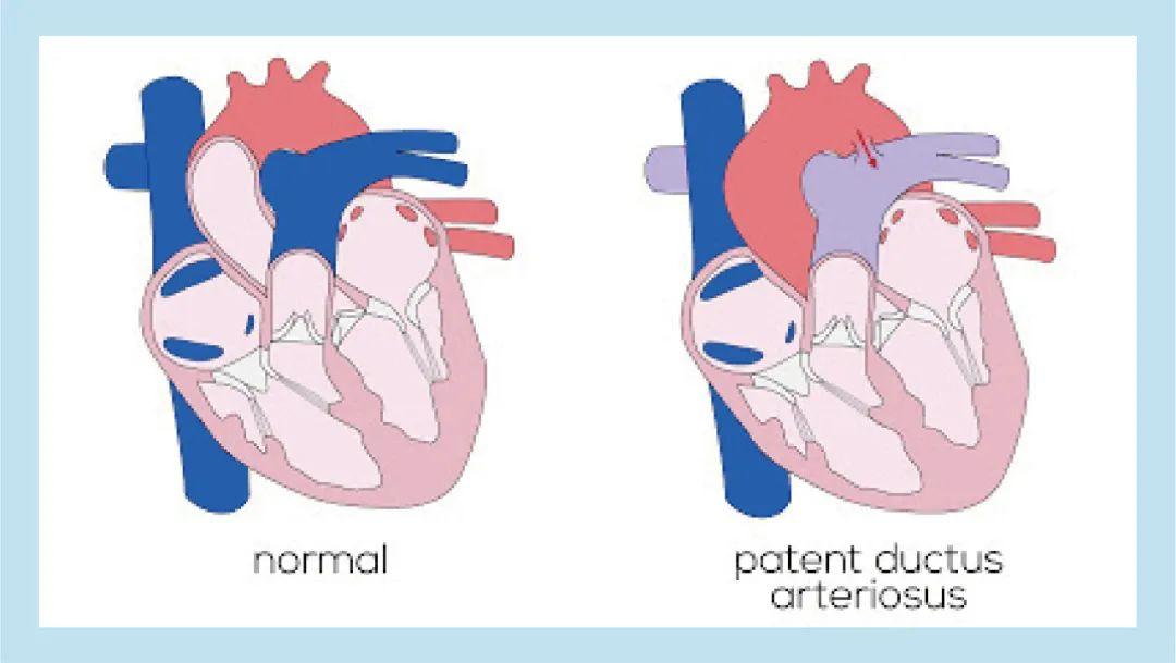 什么是儿童先天性心脏病?家长如何避免和预防?