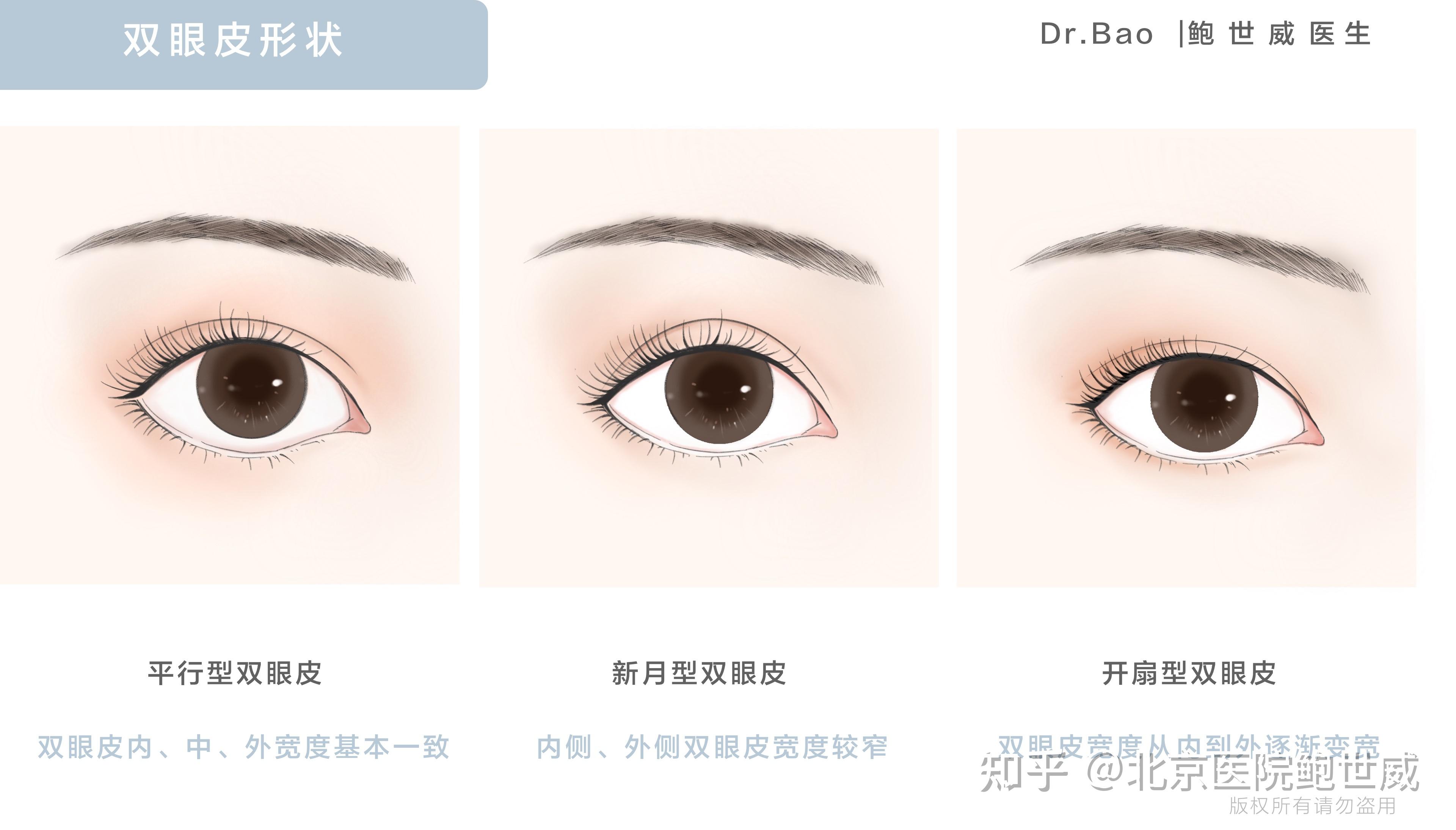 二,常见的双眼皮形状