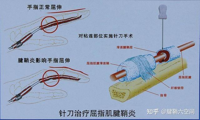 带你了解什么是小针刀疗法