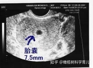 怀孕期间 学会b超的隐藏技能 用孕囊准确预测实际孕周 知乎