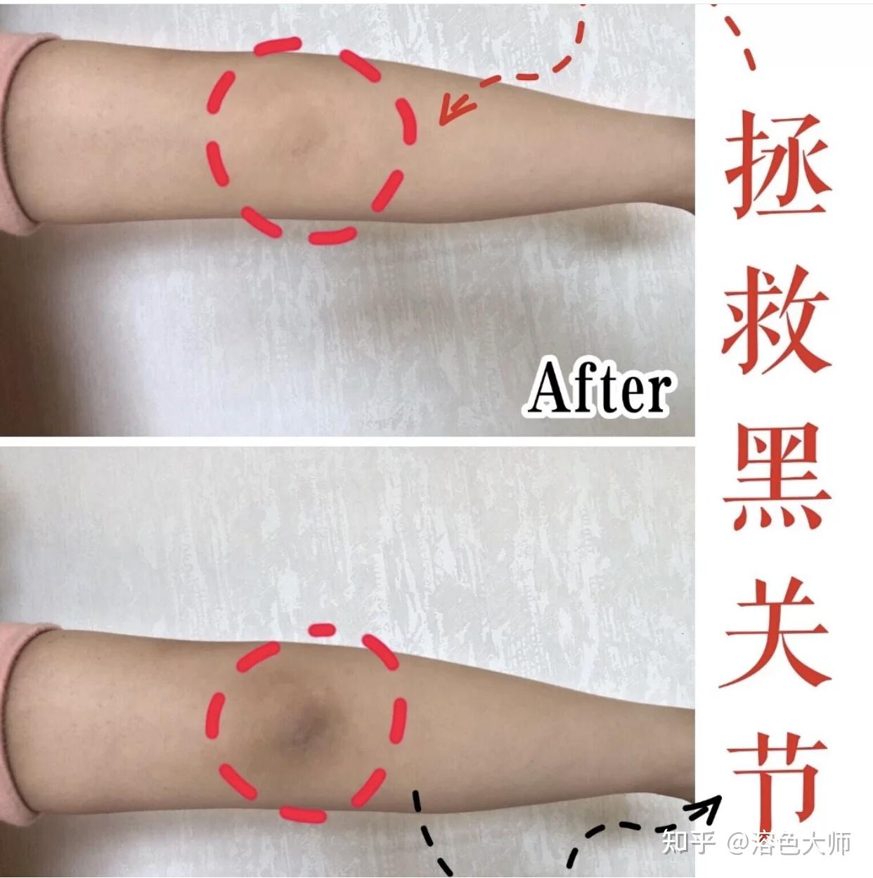 腋下黑问题 - 知乎