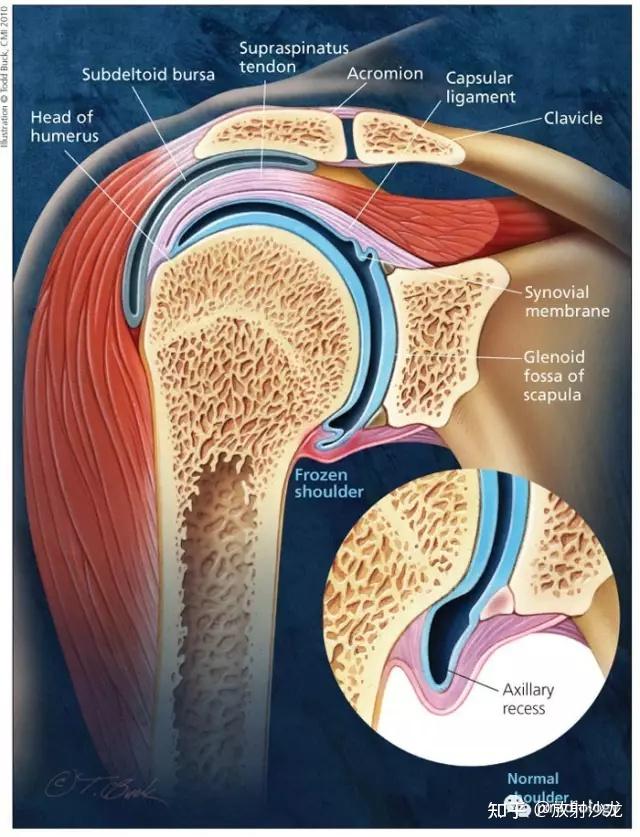 肩关节粘连图解图片