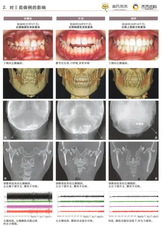 正畸科普 颈部肌肉异常对颌面部骨骼会造成什么影响 知乎