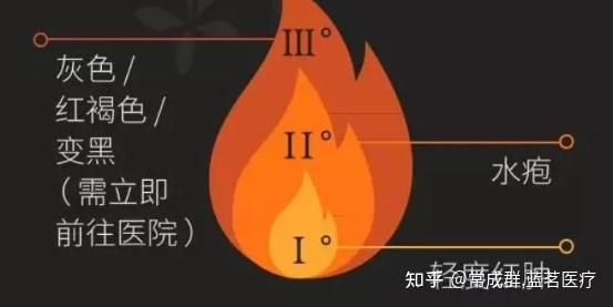 烧伤烫伤后应该如何处理? - 知乎