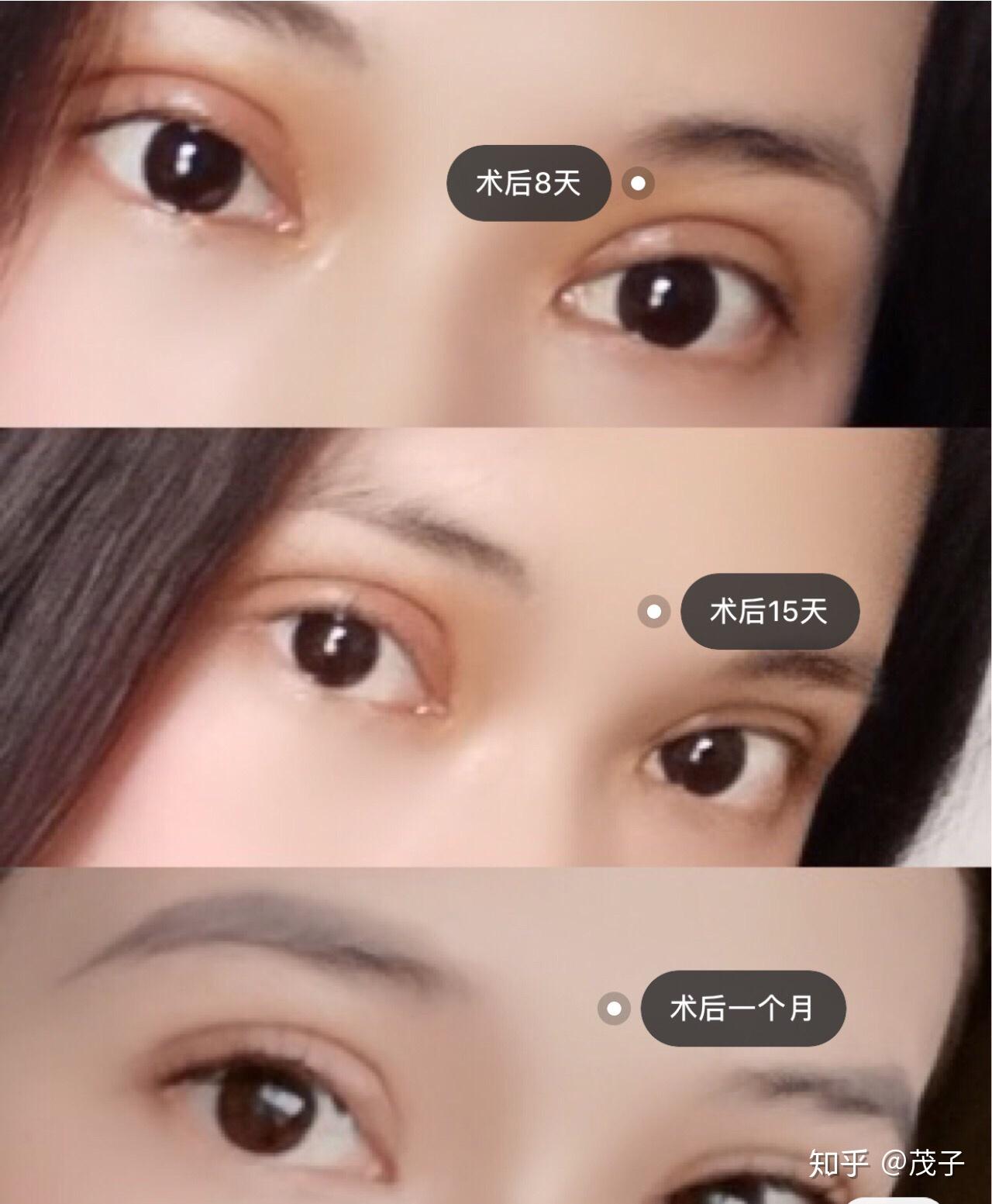 义乌割双眼皮最自然的地方(义乌割双眼皮最自然的地方是哪里)