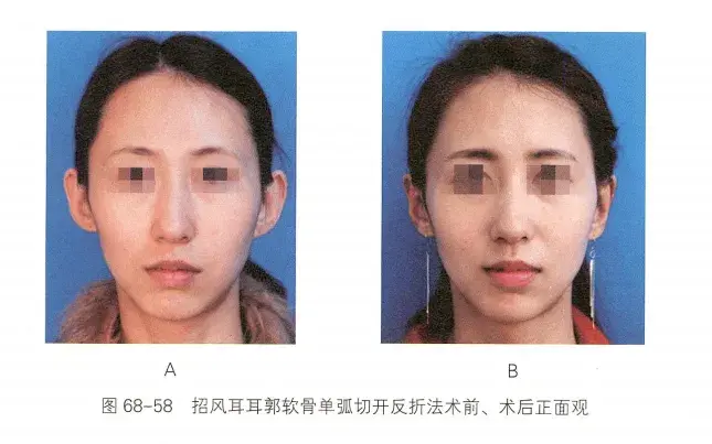 左图是术前,右图是术后 - 知乎