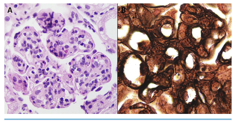 一例特殊发病机制的继发性肾病综合征