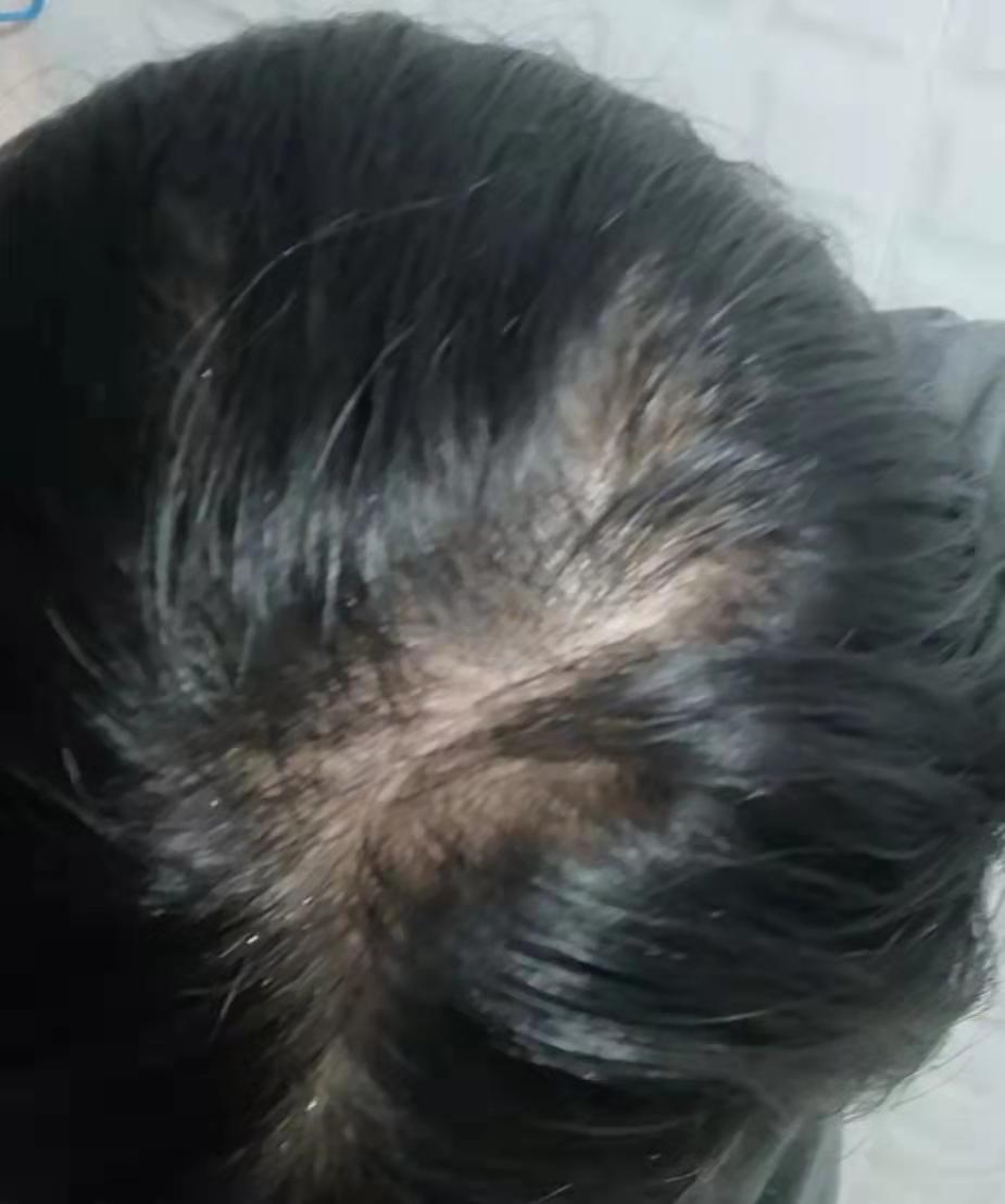 如果是脂溢性脱发,是不是会一直脱下去,没有好的办法治疗?