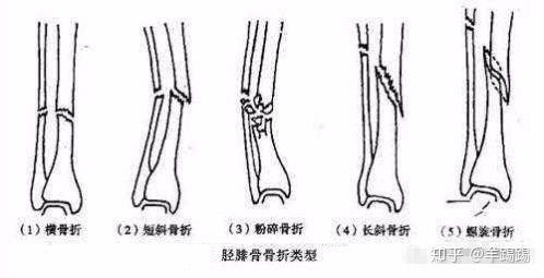 脛腓骨骨折是如何復健的是如何治療的患者脛腓骨骨折原創 羊踢踢52