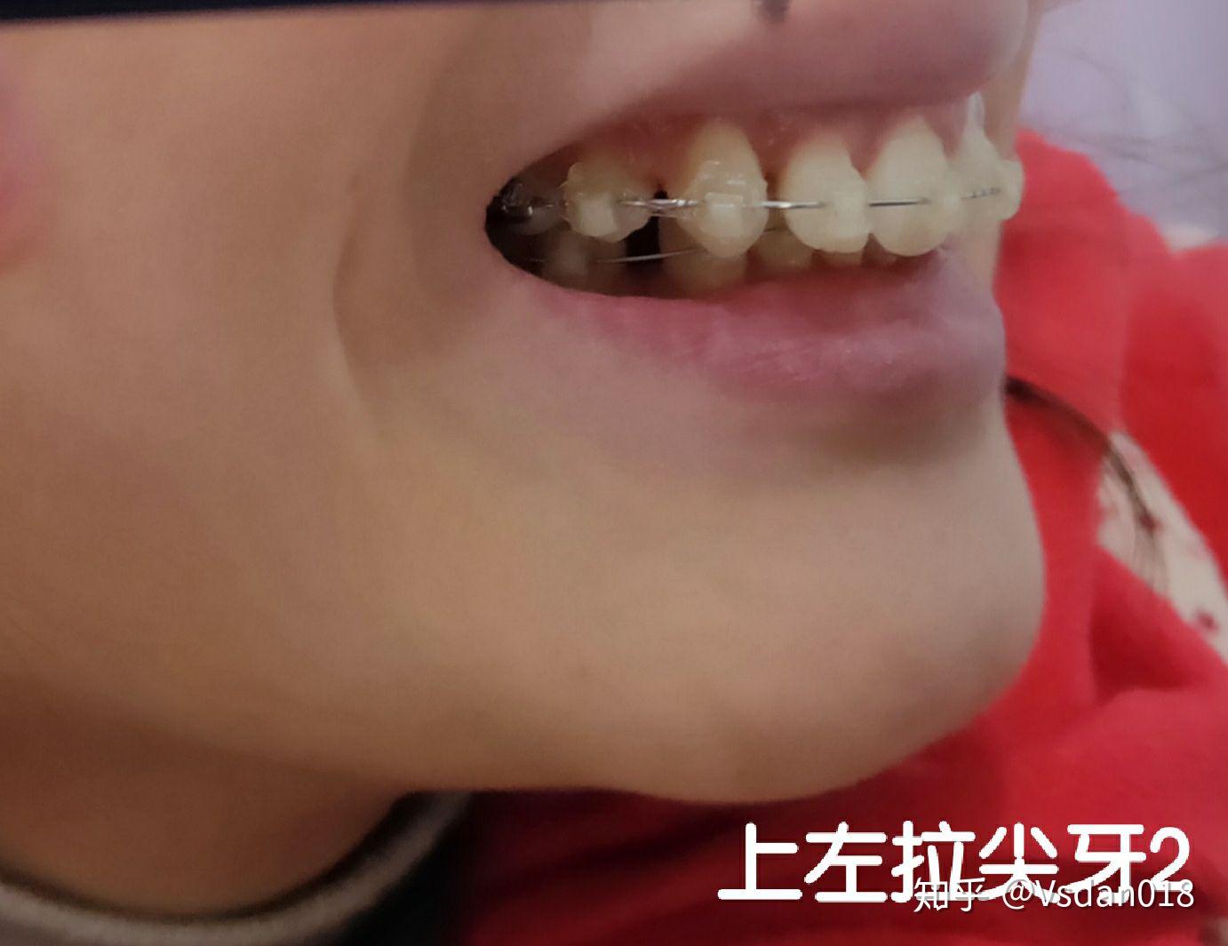 医生给我下牙上了摇椅弓丝,上牙继续拉尖牙且前四颗也上了橡皮链