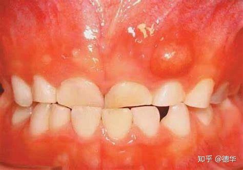 牙根尖脓肿严重的图片图片