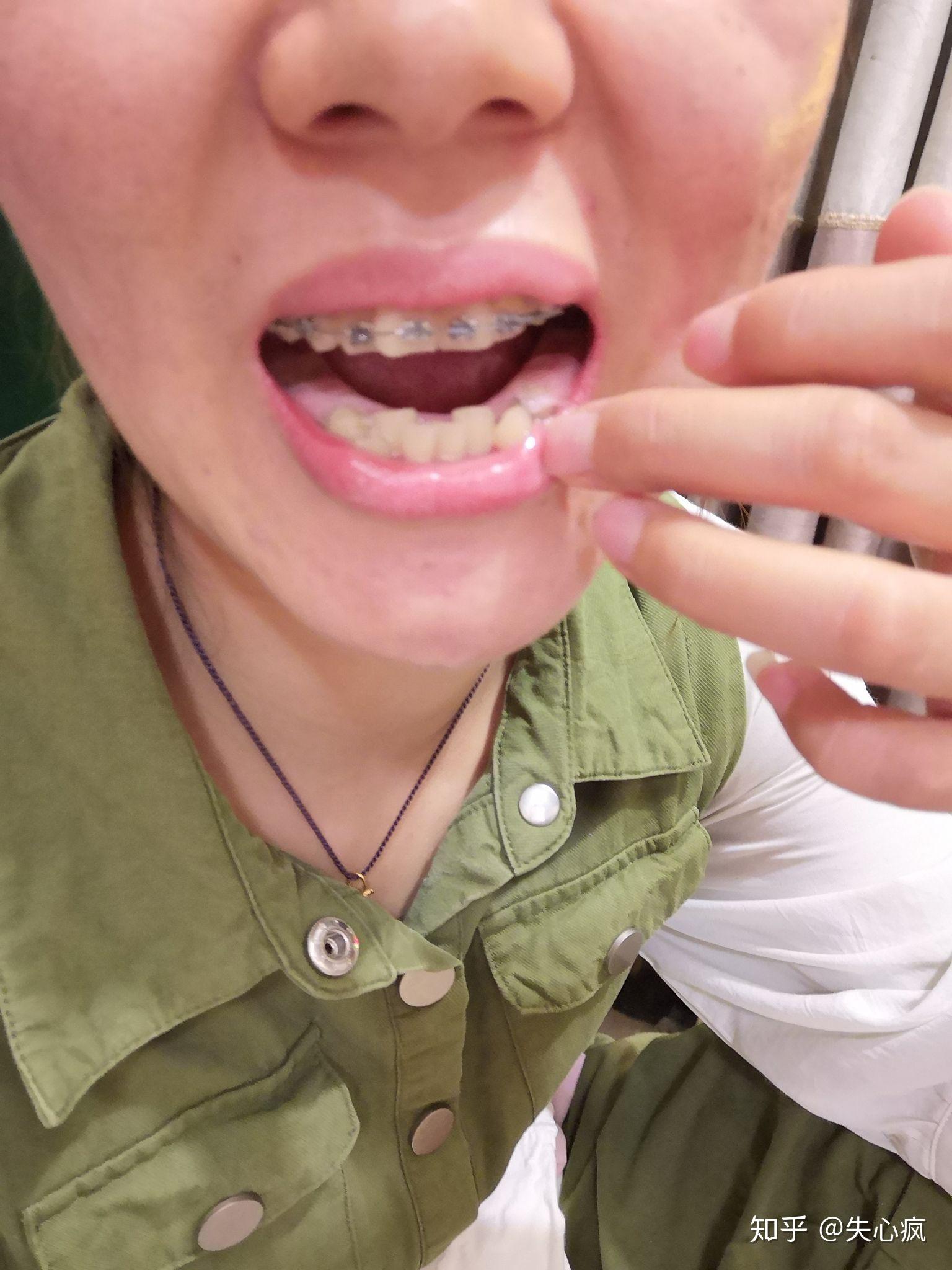 戴牙箍已经一个星期了,暂时还没啥变化.