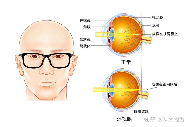 屈光不正如何筛查?上海发布筛查规范