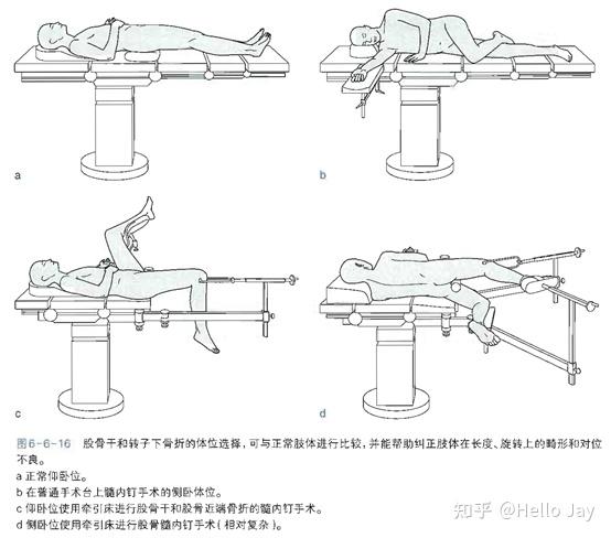 股骨颈骨折保守治疗图片