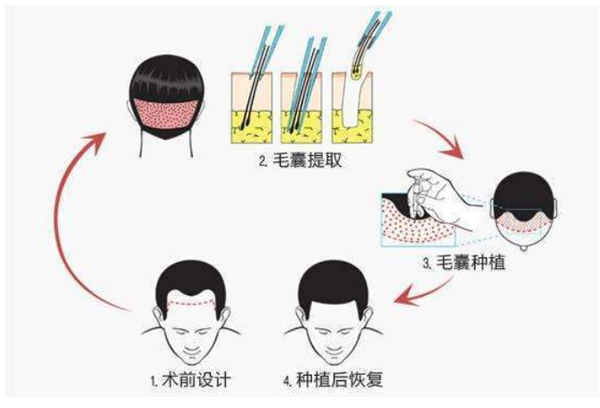 植发要多少钱一般（自己怎么预估植发价格）