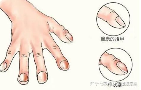 会发生杵状指的疾病 - 知乎