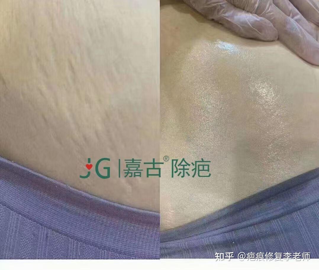 妊娠纹修复纹淡化了平整了