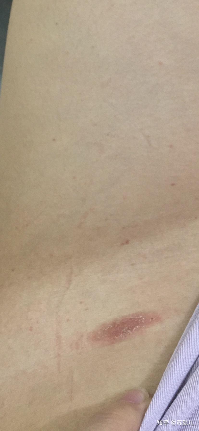 再也别见了,玫瑰糠疹!