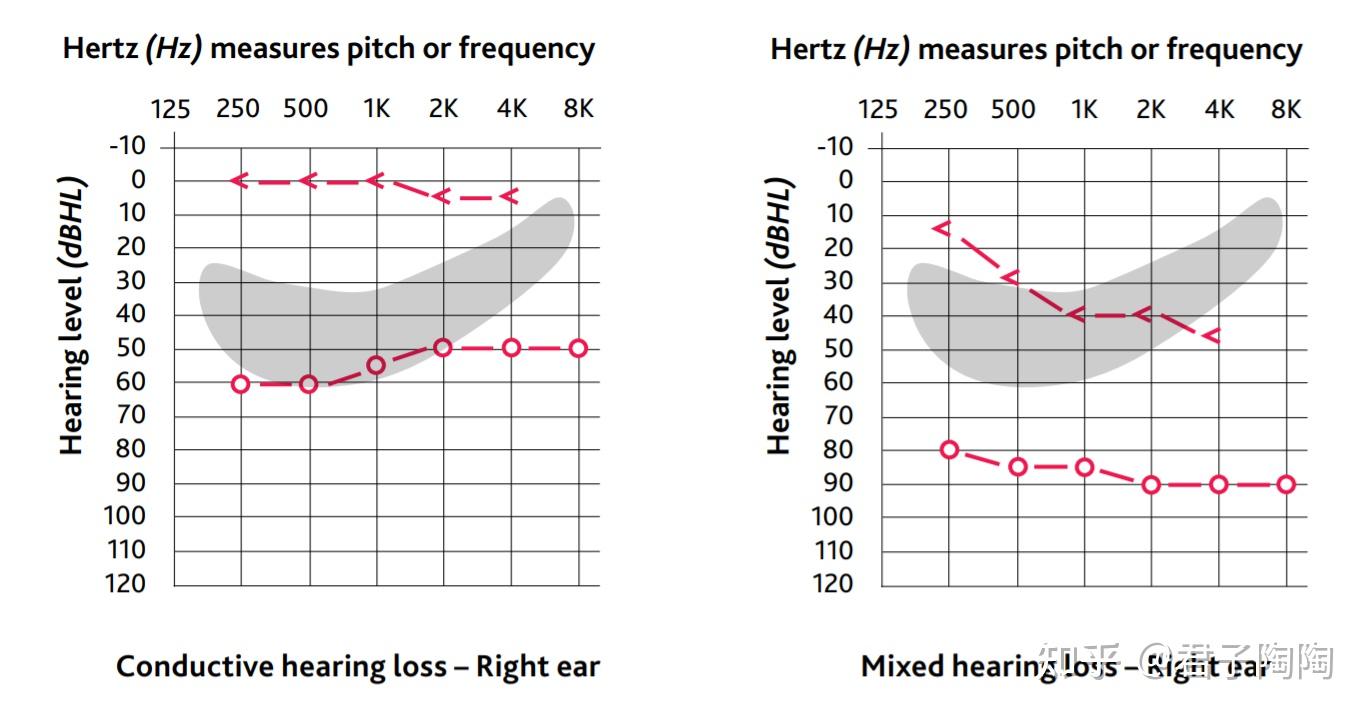 左侧图为混合性的听力损失