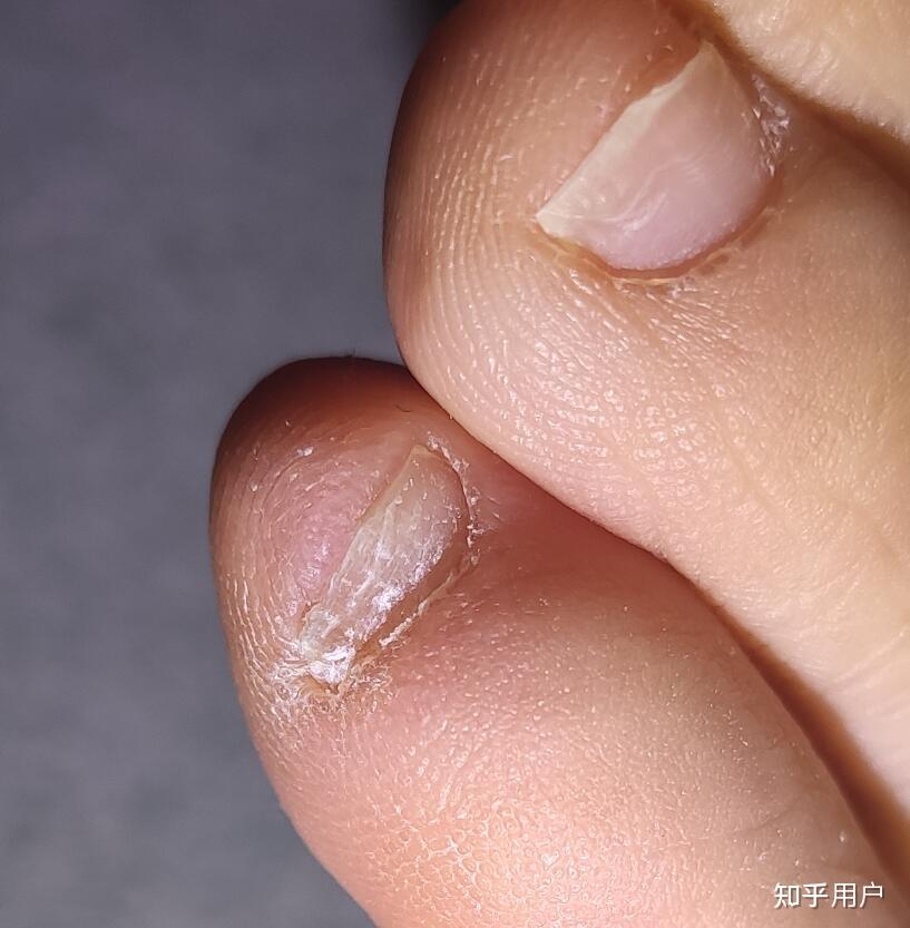 灰指甲前期长什么样子? - 知乎