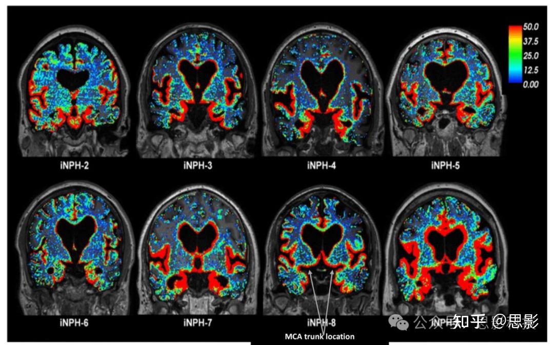 MRI影像中自动检测和定量分析扩大的血管周围间隙（PVS）的方法 - 知乎