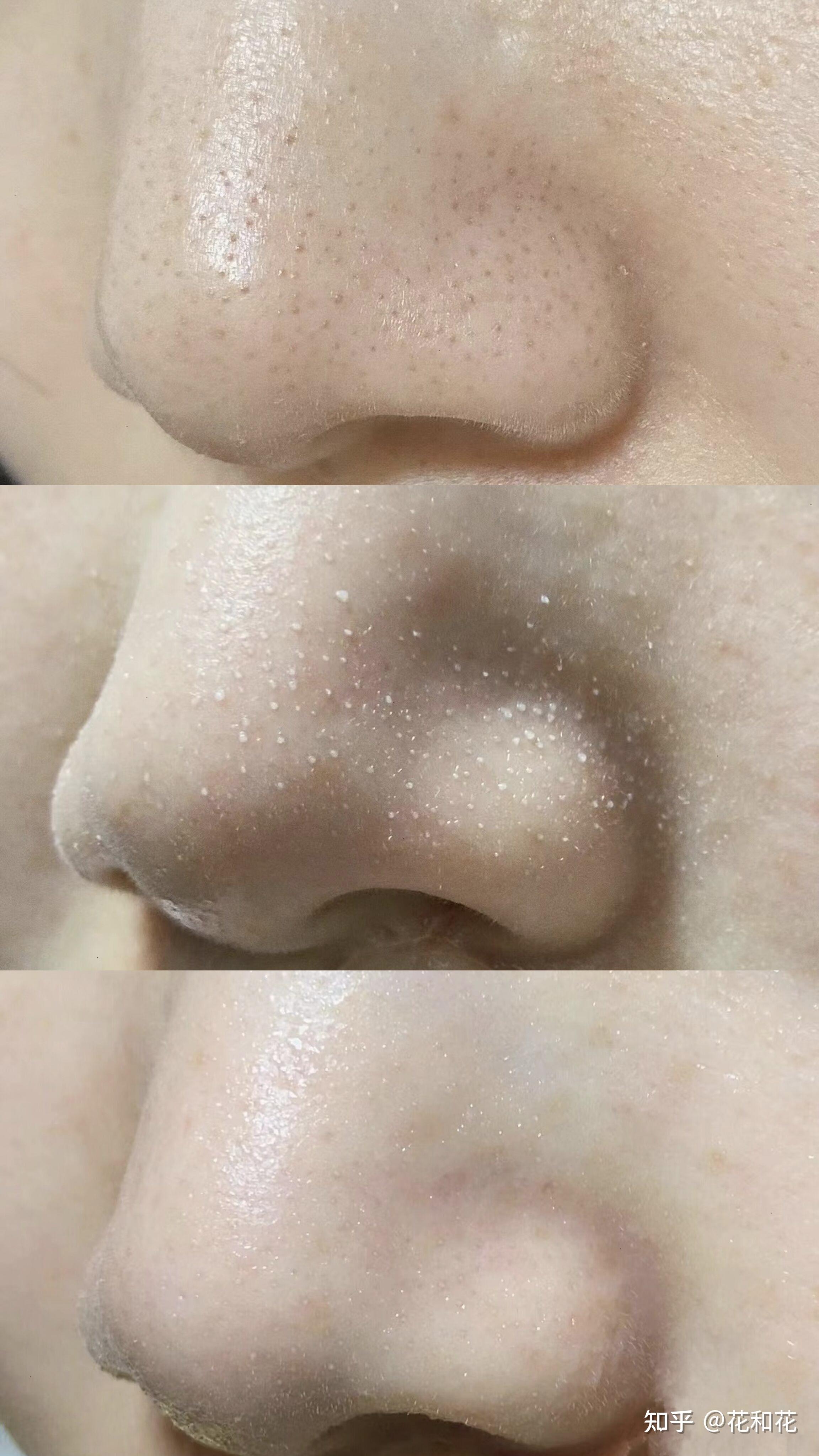 黑头摸起来一颗颗的,毛孔大的能插秧,有什么可以根除黑头方法? - 知乎