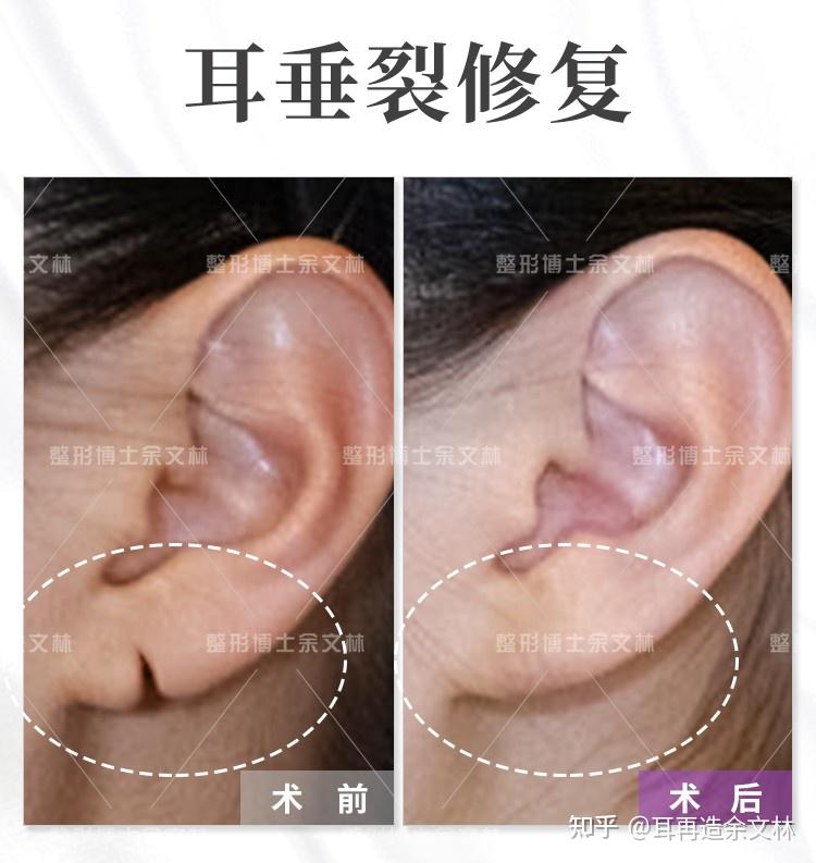 原来戴耳环真的会导致耳垂裂开王一博他们就是一个例子