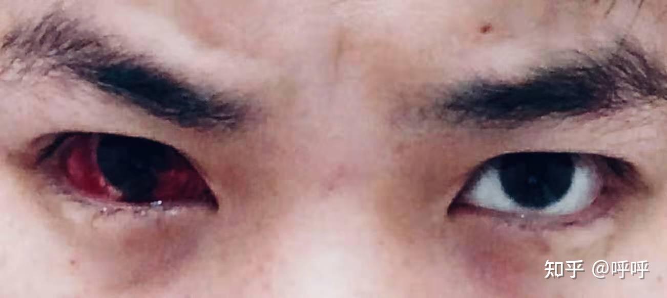 单眼失明是种怎样的体验