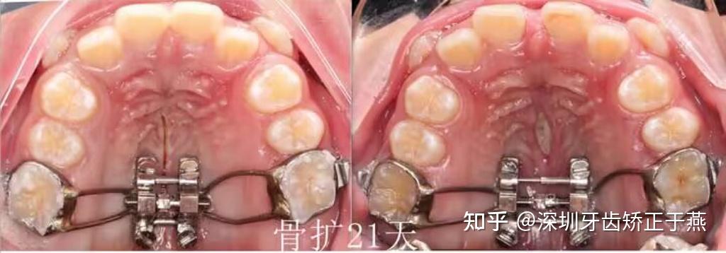 牙齿扩弓有没有年龄限制? - 知乎