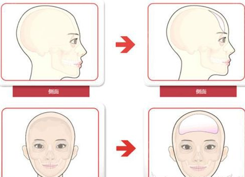 假体可以丰额头但不知道选择硅胶好还是膨体好 知乎