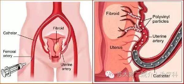 子宫肌瘤 腺肌症介入术后的不适及处理 知乎