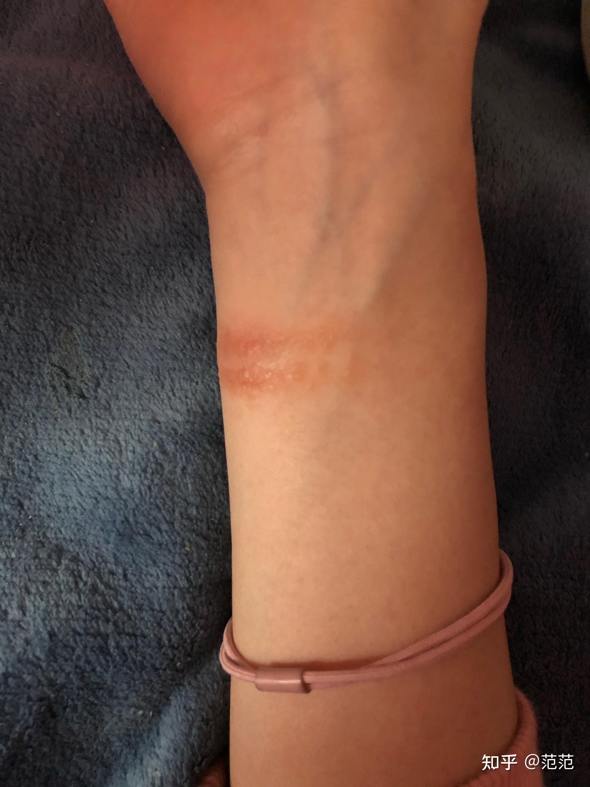 有没有带小米手环过敏的