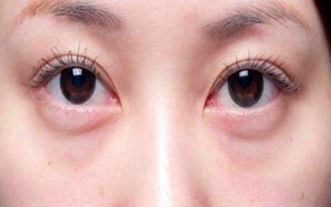 熬夜眼袋不能自行恢复怎么恢复会更好素目教你