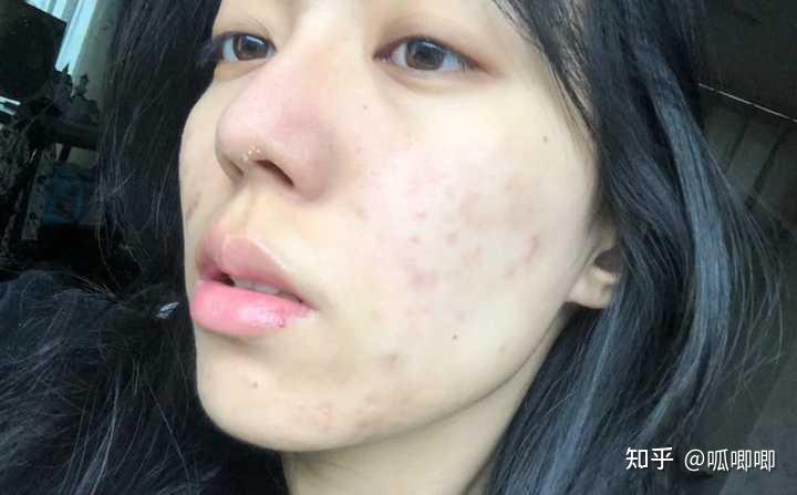 怎么淡化痘印跪求良心推荐