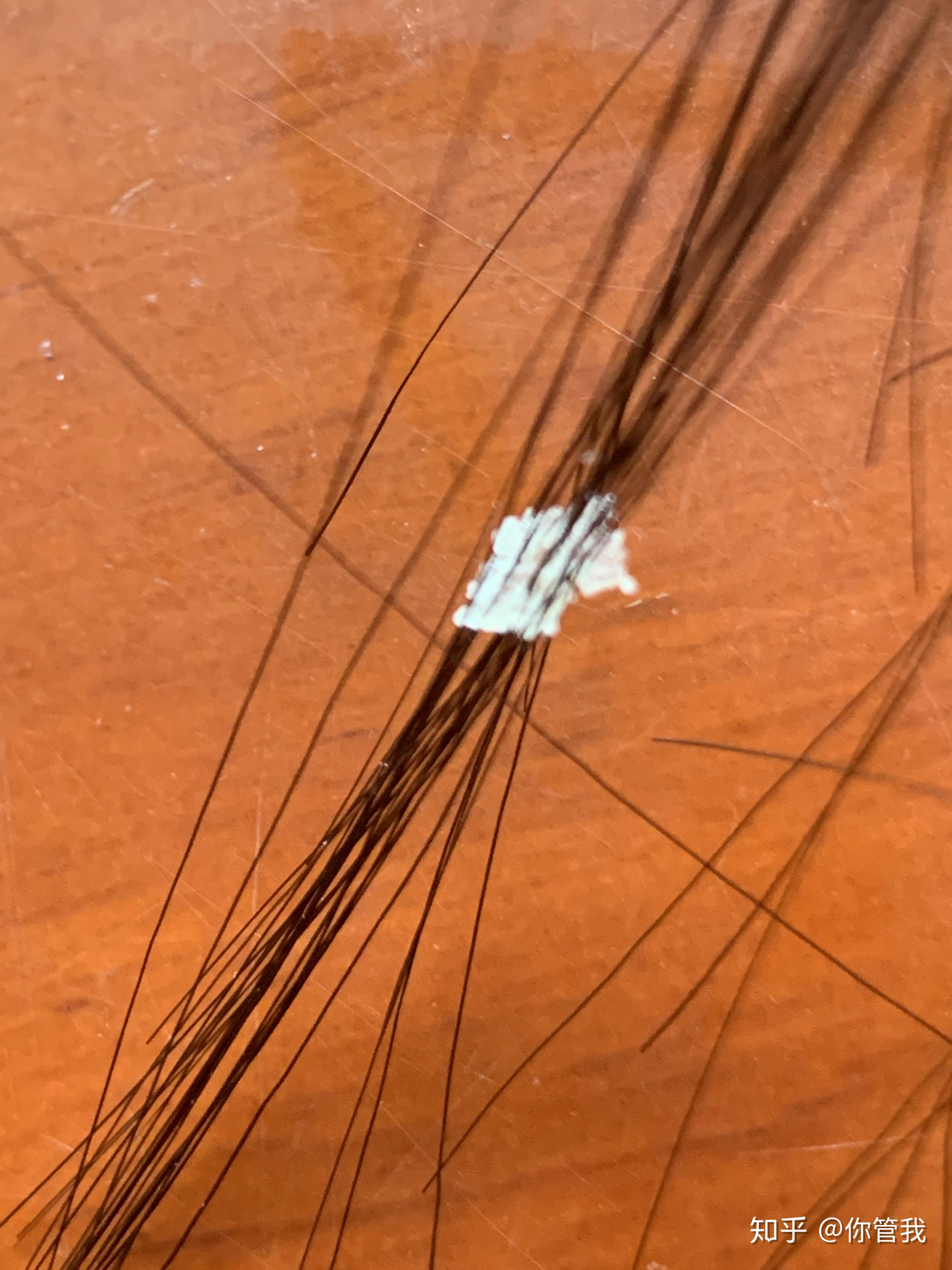 见过的最大头皮屑多大