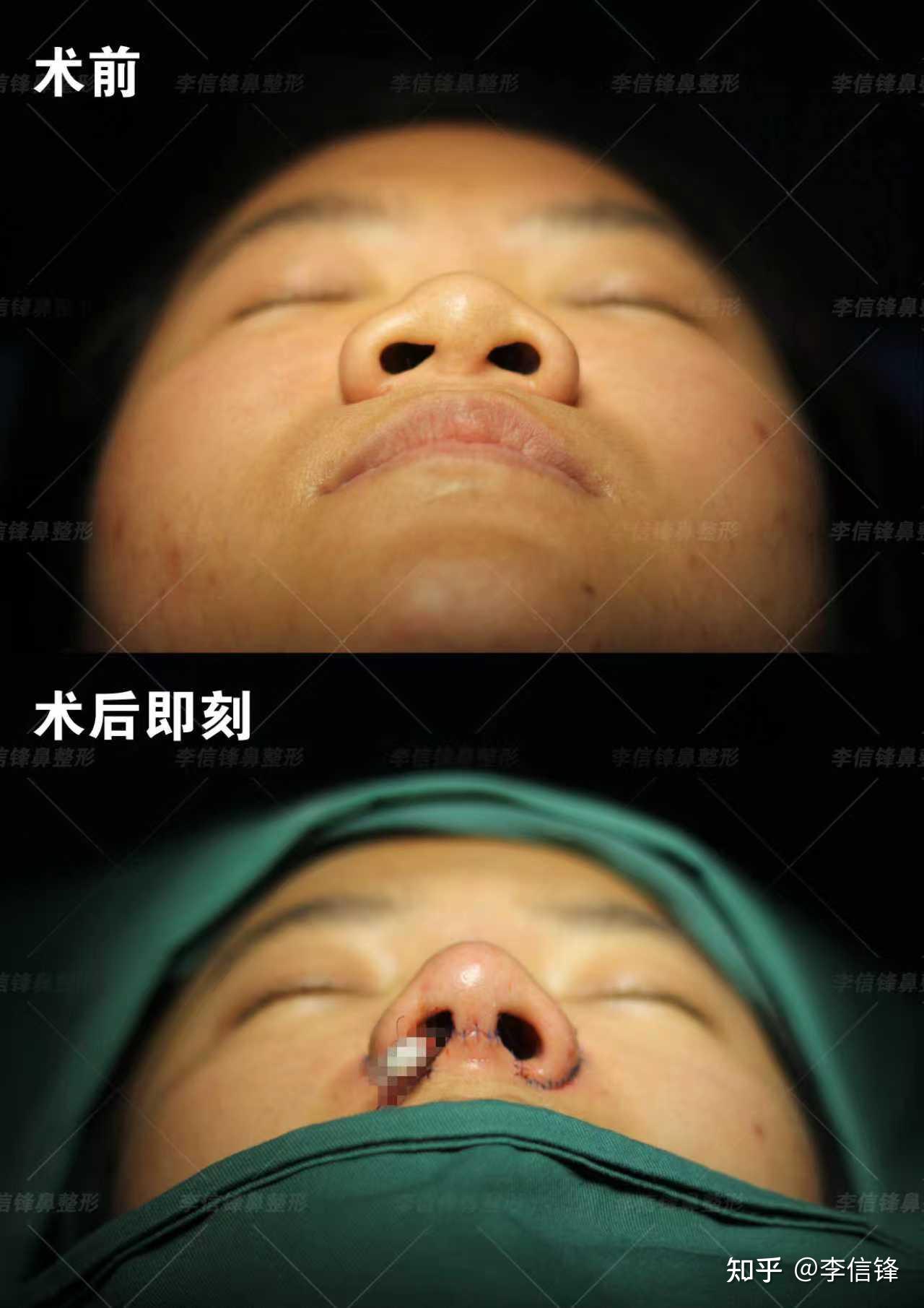 深圳初鼻鼻综合|面中凹陷 + 大鼻头 + 嘴凸,一次手术直接改掉骨相! - 知乎