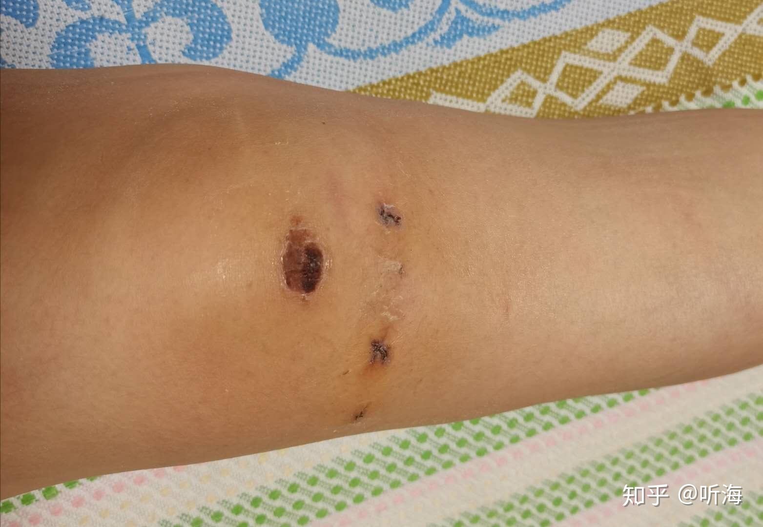 半月板手术后伤口图片图片