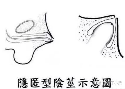 隐匿性的丁丁又叫做隐匿阴茎,是由于耻骨前皮下脂肪丰富,而附着于阴茎