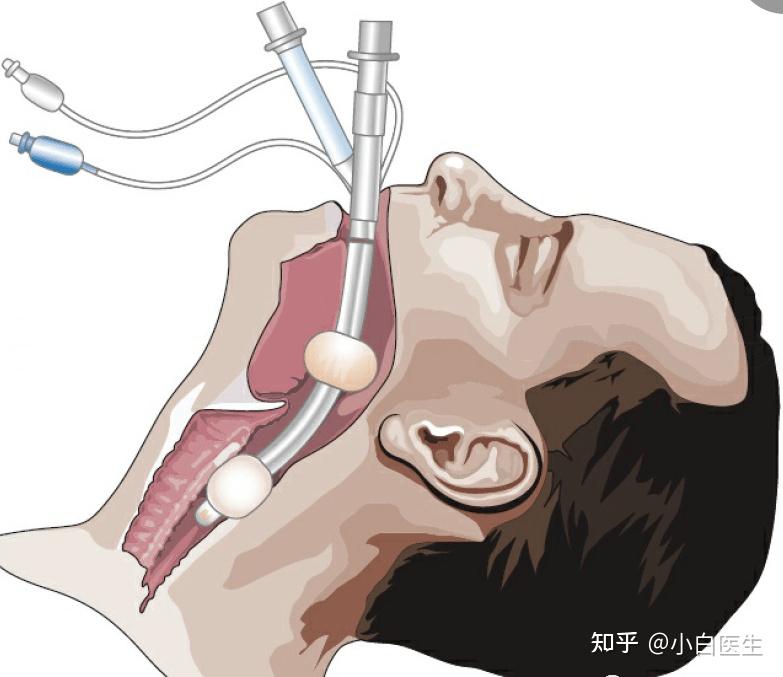 气管插管图片卡通图片