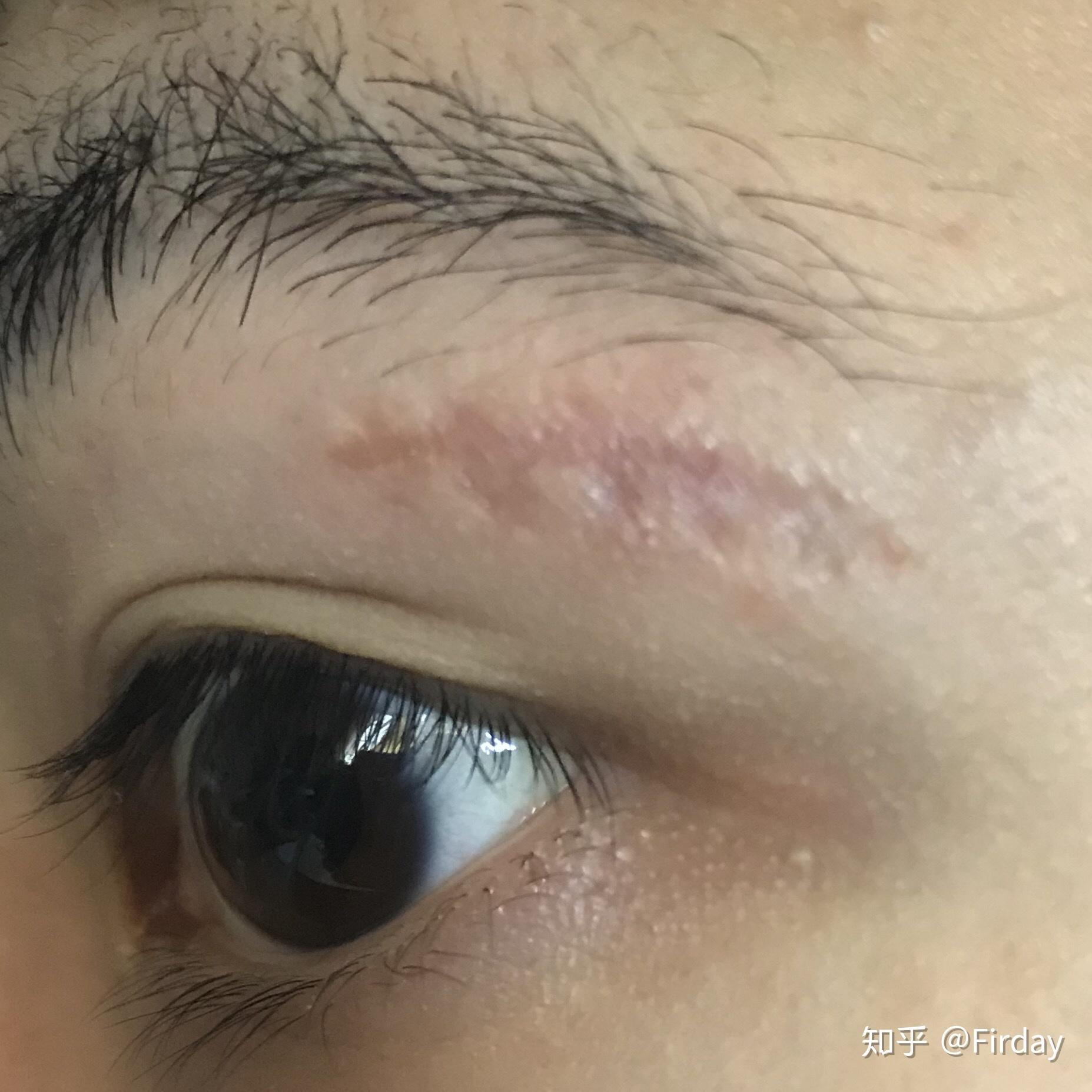 手术疤痕 - 知乎