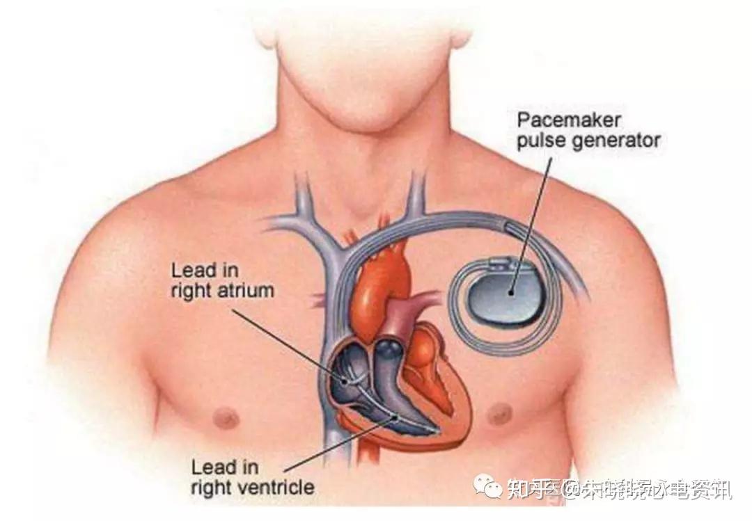 心动过缓与心脏起搏器